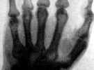 Entdeckung der Röntgenstrahlen - X-Strahlen
