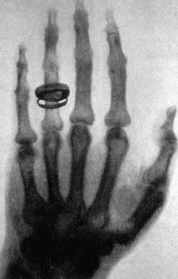 Röntgenaufnahme am 23.01.1896: : Albert Köllikers Hand (mit Ring), aufgenommen von Conrad Röntgen.